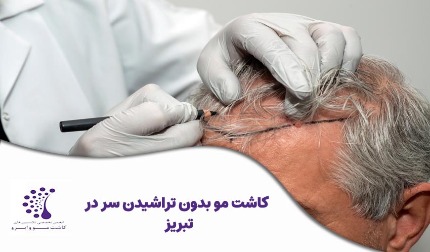 کاشت مو بدون تراشیدن سر در تبریز