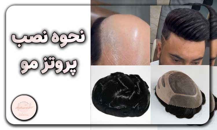 نحوه نصب پروتز مو