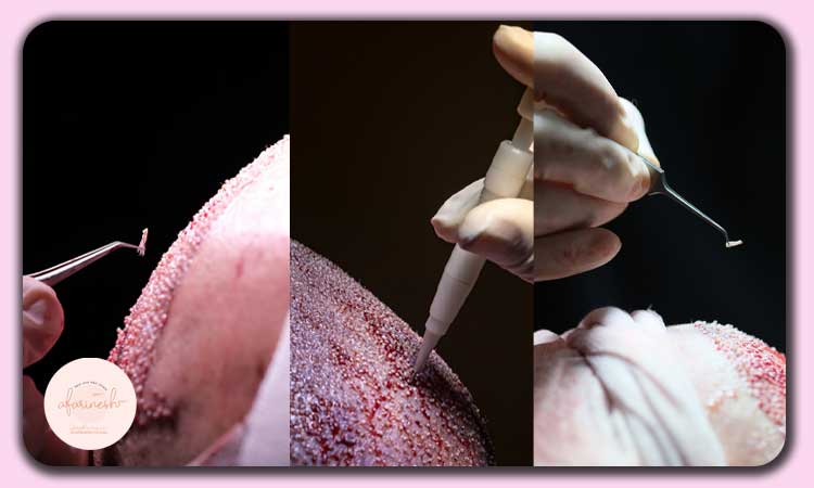 روش های کاشت مو بدون بانک مو در شیراز