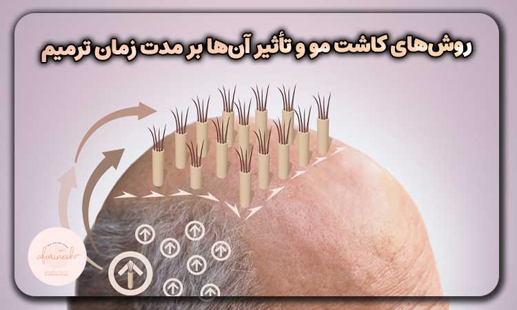 روش های کاشت مو و تأثیر آن ها بر مدت زمان ترمیم