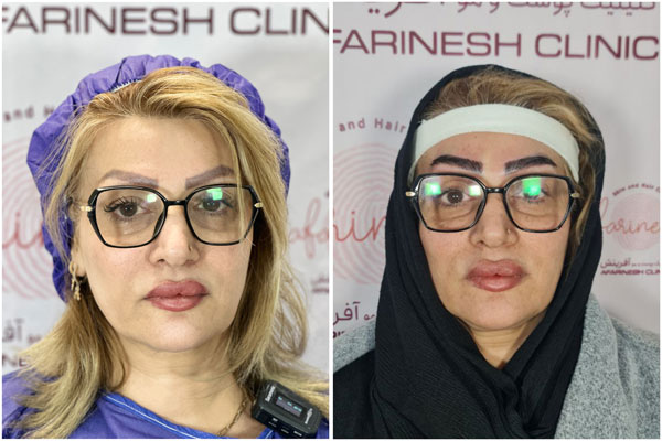 قبل بعد کاشت ابرو طبیعی