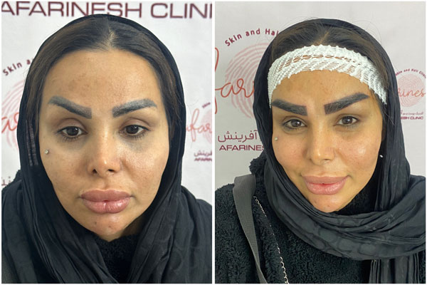 عکس کاشت ابرو بعد از یکسال