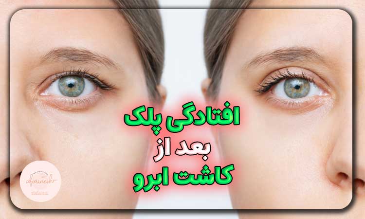 افتادگی پلک بعد از کاشت ابرو
