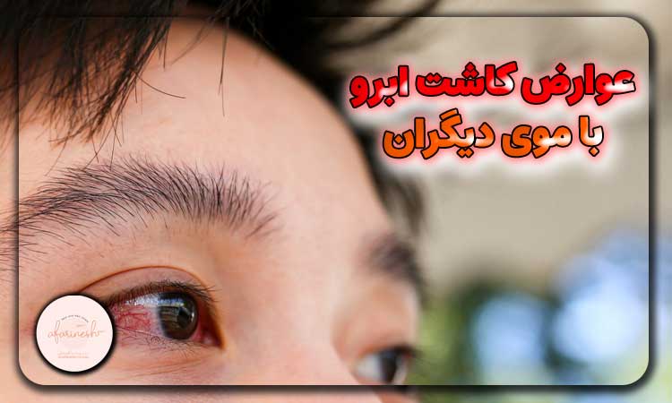 عوارض کاشت ابرو با موی دیگران