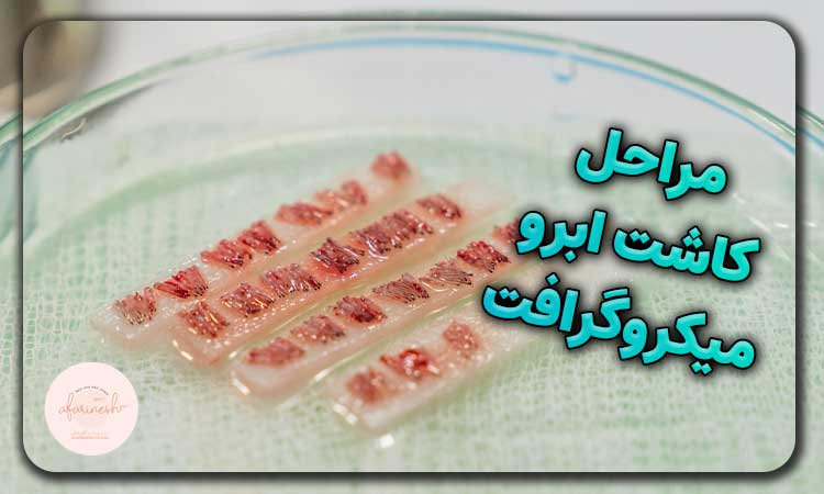 مراحل کاشت ابرو به روش میکروگرافت