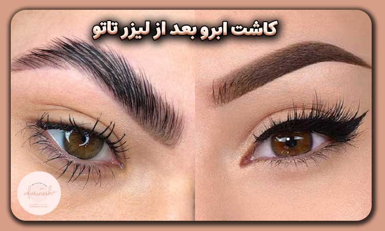 کاشت ابرو بعد از لیزر تاتو