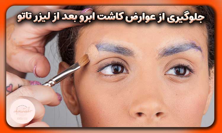 جلوگیری از عوارض کاشت ابرو بعد از لیزر تاتو