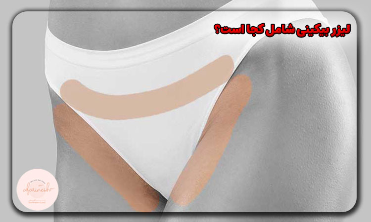 لیزر بیکینی شامل کجا است؟