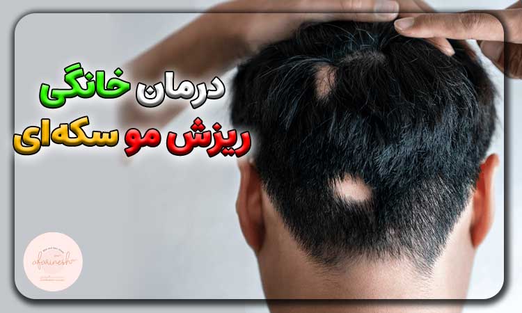 درمان خانگی ریزش مو سکه ای