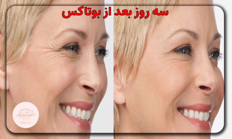 سه روز بعد از بوتاکس