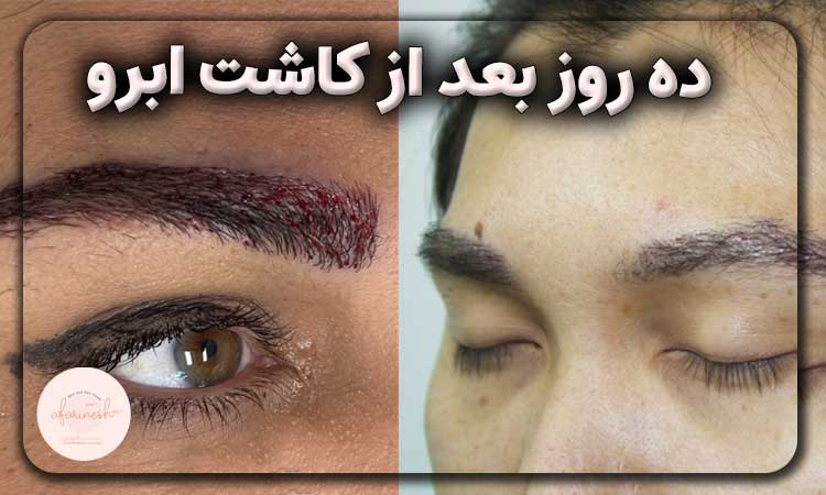 ده روز بعد از کاشت ابرو