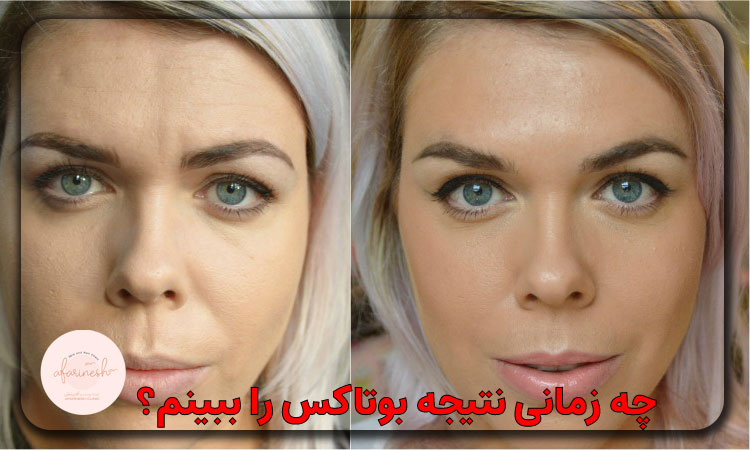 چه زمانی نتیجه بوتاکس را ببینم؟