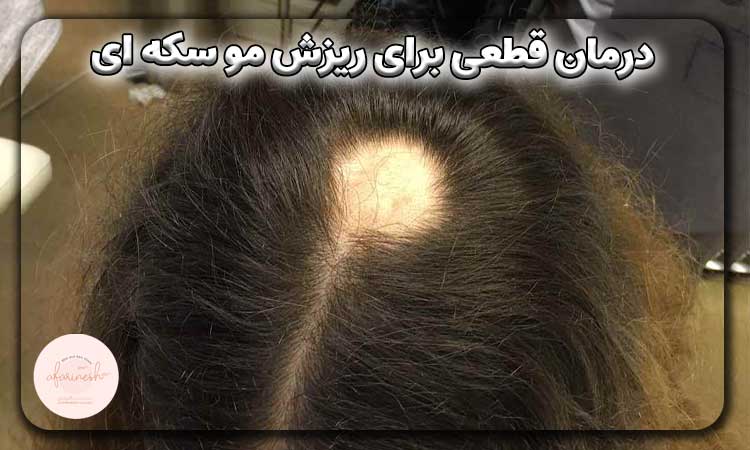 درمان قطعی برای ریزش مو سکه ای