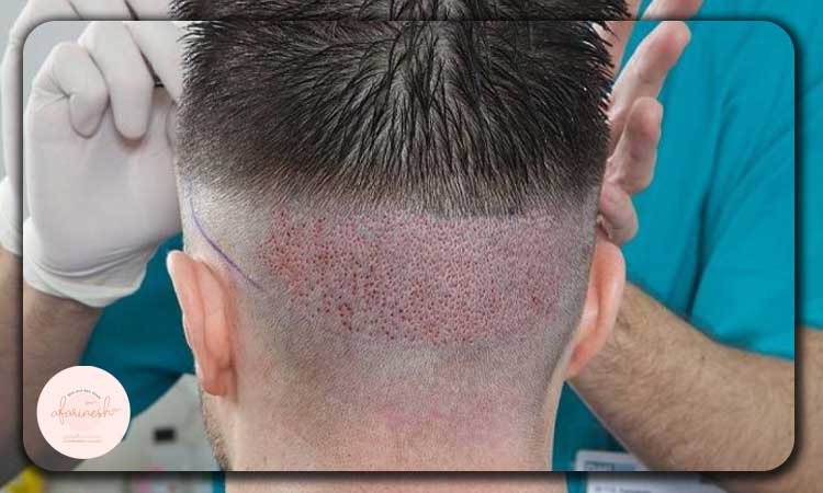 بانک مو ضعیف برای کاشت ابرو