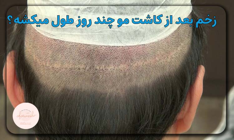 زخم کاشت مو چند روز طول میکشد