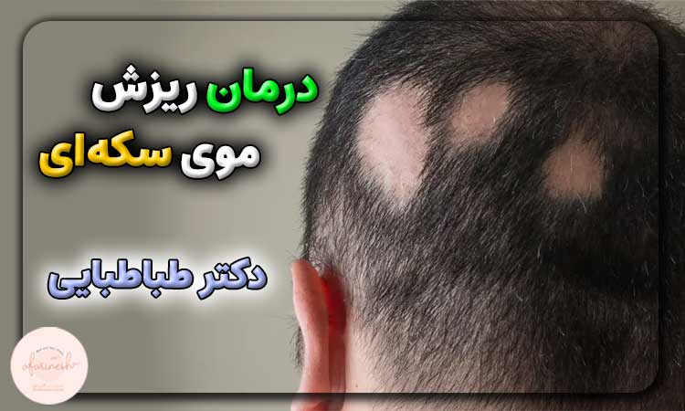 درمان ریزش موی سکه ای از نظر دکتر طباطبایی