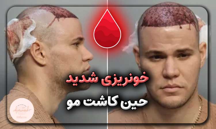 خونریزی شدید حین کاشت مو