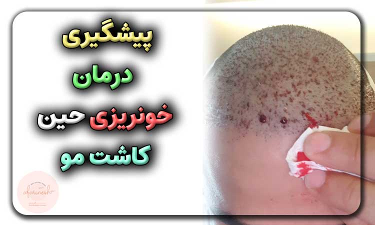 پیشگیری و درمان خونریزی حین کاشت مو