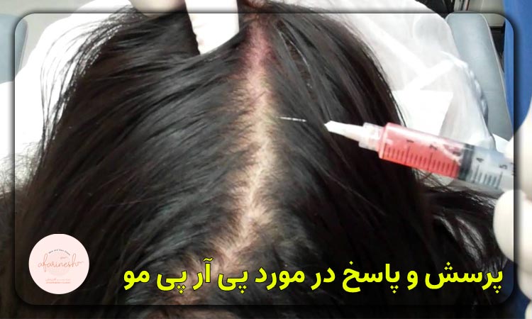 پرسش و پاسخ در مورد پی آر پی مو