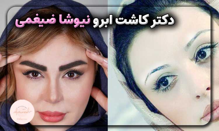 دکتر کاشت ابرو نیوشا ضیغمی