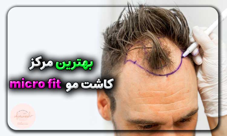 بهترین مرکز کاشت مو به روش micro fit