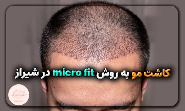 کاشت مو به روش micro fit در شیراز