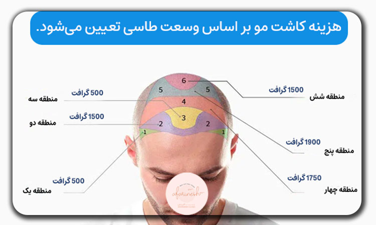 هزینه کاشت مو در شیراز چگونه محاسبه میشود؟