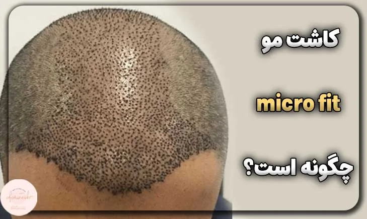 کاشت مو به روش micro fit چگونه است؟