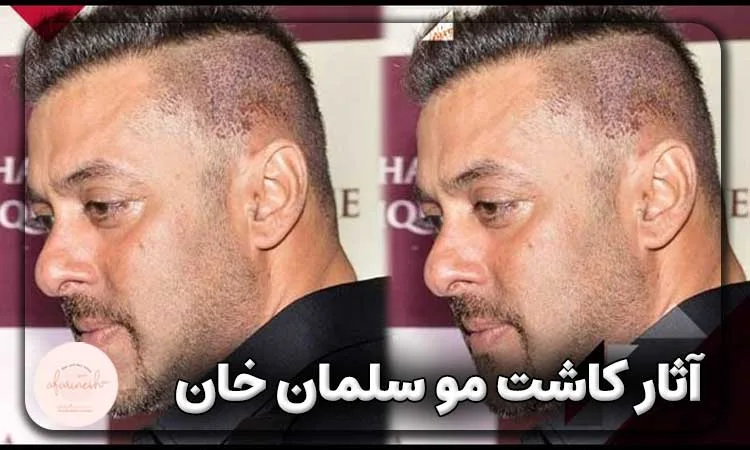 آیا سلمان خان مو کاشته است؟