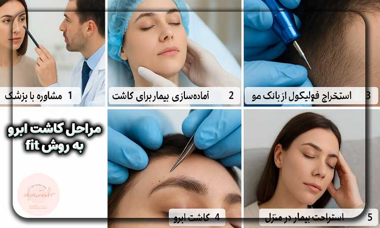 مراحل کاشت ابرو به روش fit