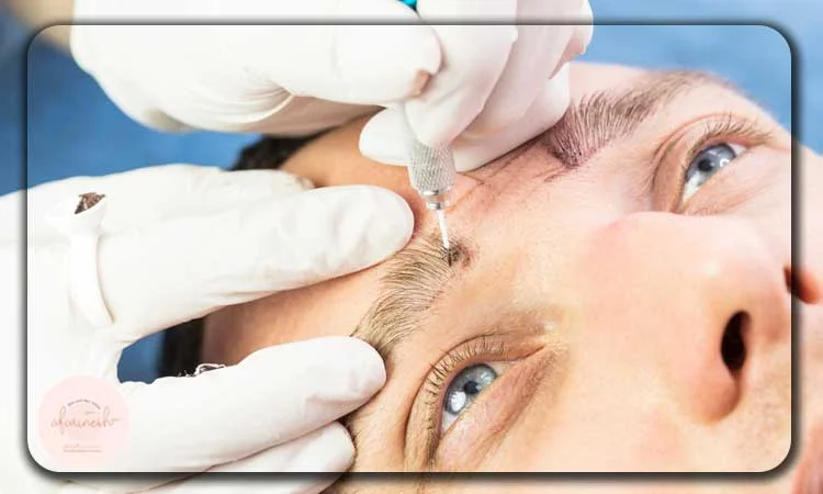 علت انجام میکروبلیدینگ ابر مردانه