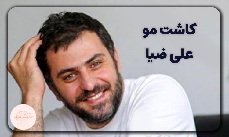 علی ضیا قبل از کاشت مو