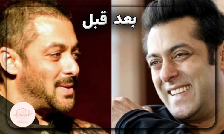 قبل و بعد کاشت مو سلمان خان