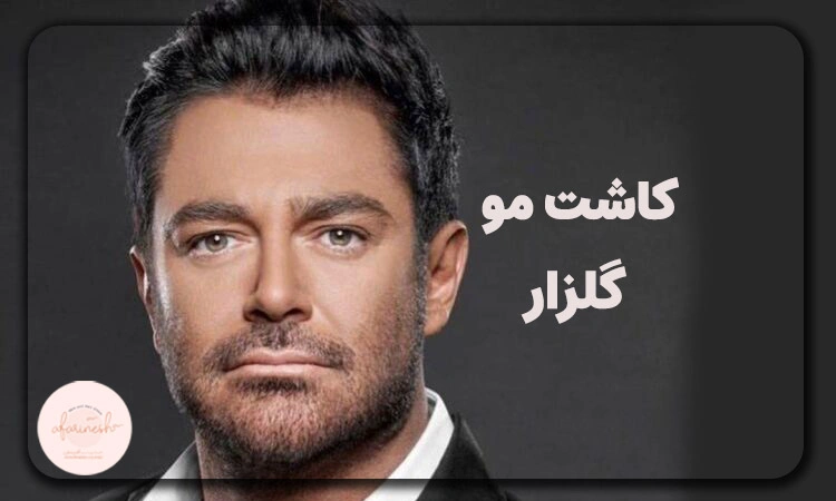 محمدرضا گلزار قبل از کاشت مو