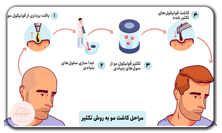 مراحل کاشت مو به روش تکثیر