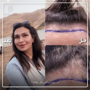 قبل و بعد کاشت مو