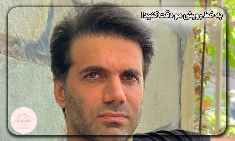 نتایج کاشت مو شیث رضایی