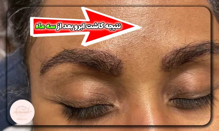 نتیجه کاشت ابرو بعد از سه ماه