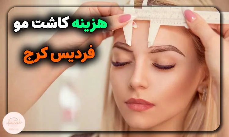هزینه کاشت مو در فردیس کرج