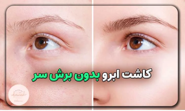 کاشت ابرو بدون برش سر