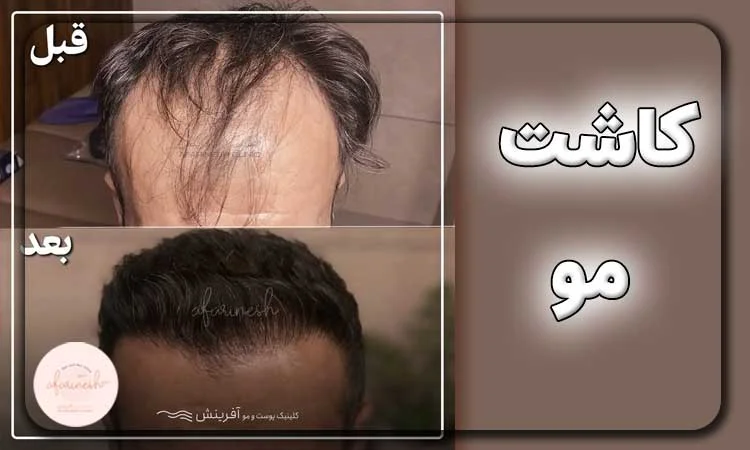 کاشت مو