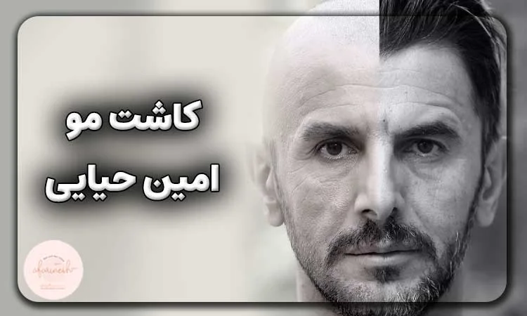 کاشت مو امین حیایی