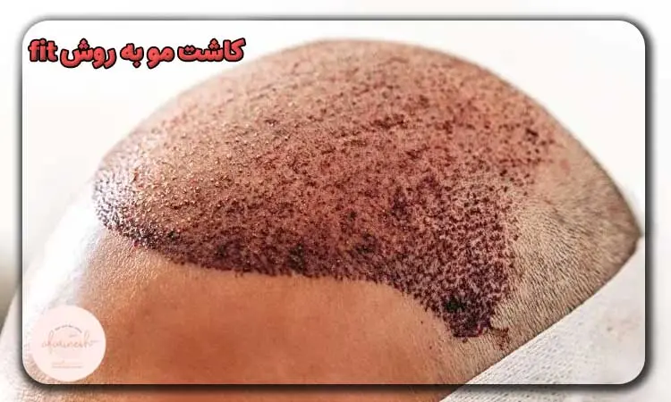 کاشت مو به روش fit
