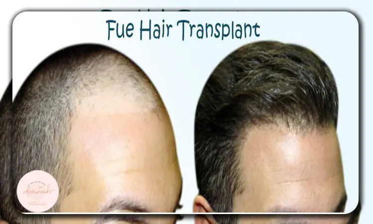 کاشت مو به روش fue چیست؟