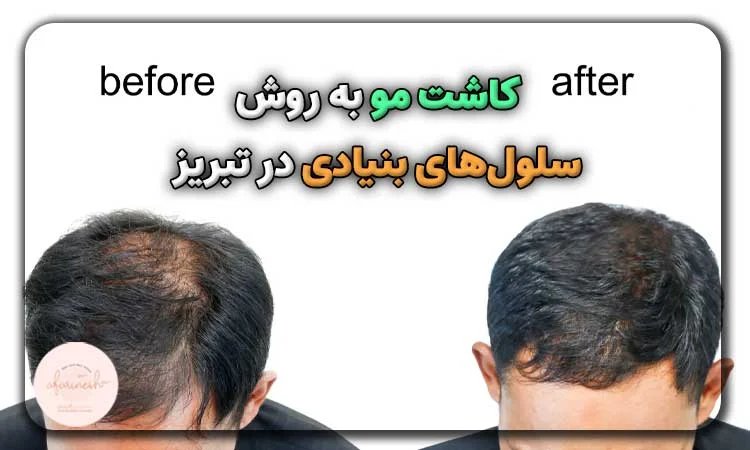 کاشت مو به روش سلولهای بنیادی در تبریز