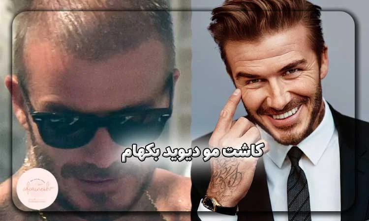 کاشت مو دیوید بکهام