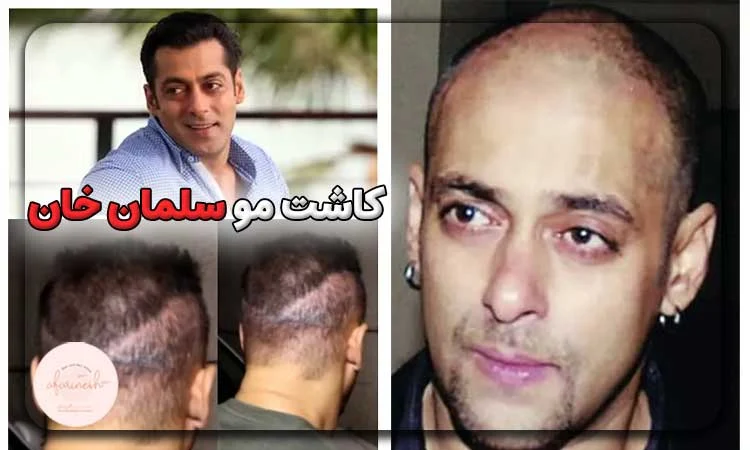 کاشت مو سلمان خان