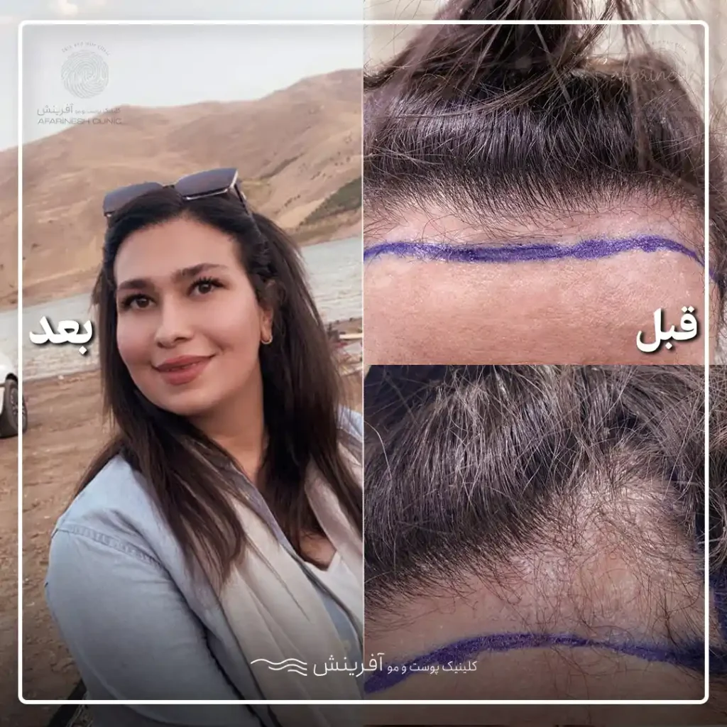 قبل و بعد کاشت مو