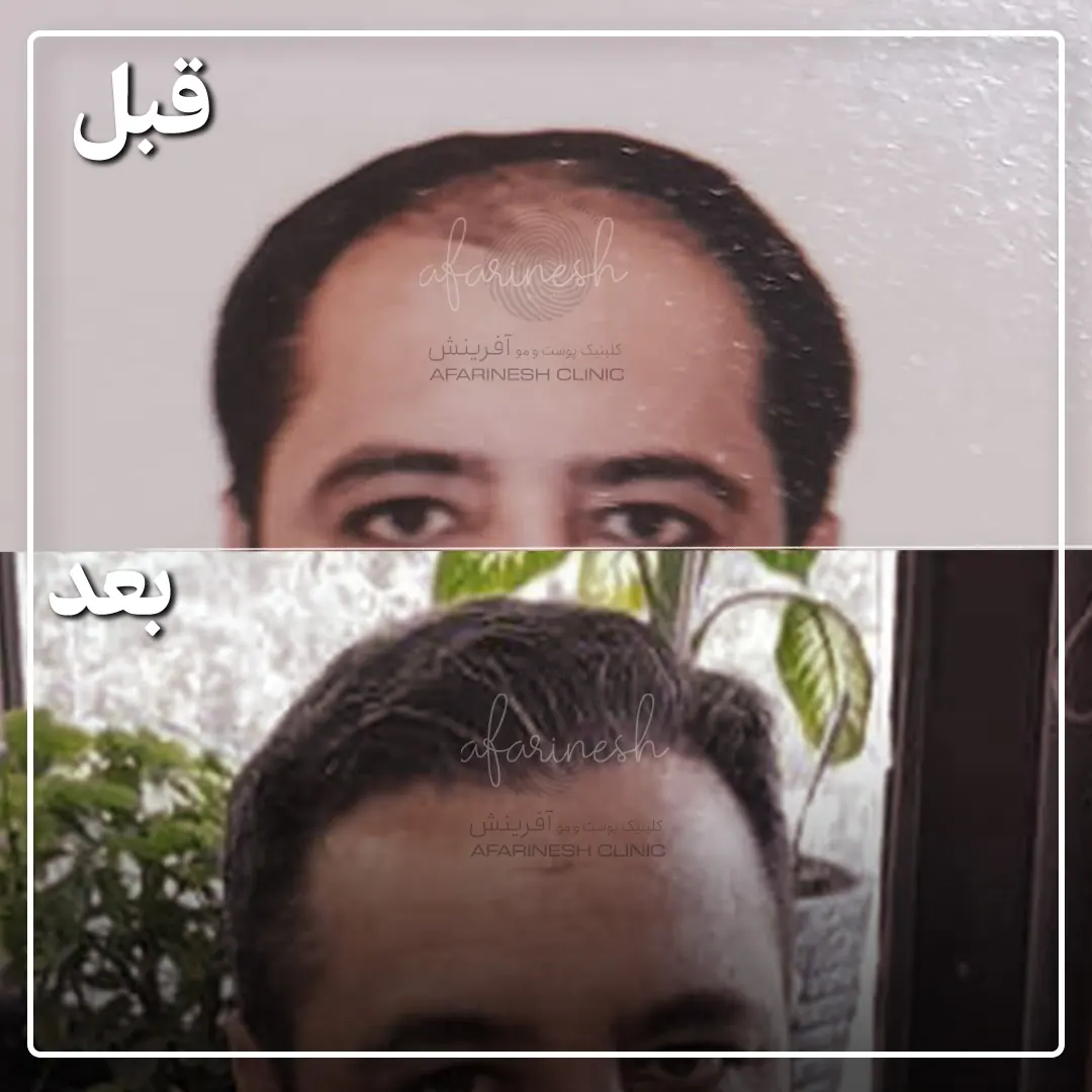 نمونه کاشت مو آفرینش