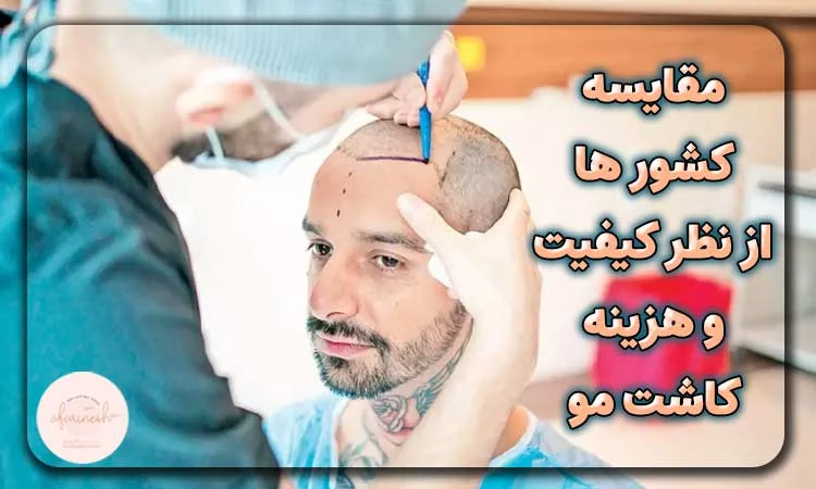مقایسه کشور ها از نظر کیفیت و هزینه کاشت مو